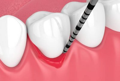 Crown Lengthening and Alveolar Ridge