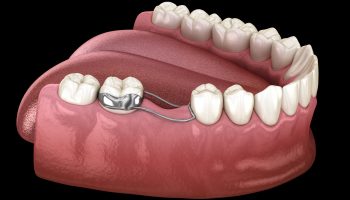 Space,Maintainer,Unilateral,Keeps,From,Teeth,Shift,Deformatiuon,After,Losing