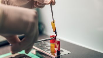 Platelet,Rich,Fibrin,Prf,In,Dental,And,Oral,Surgery